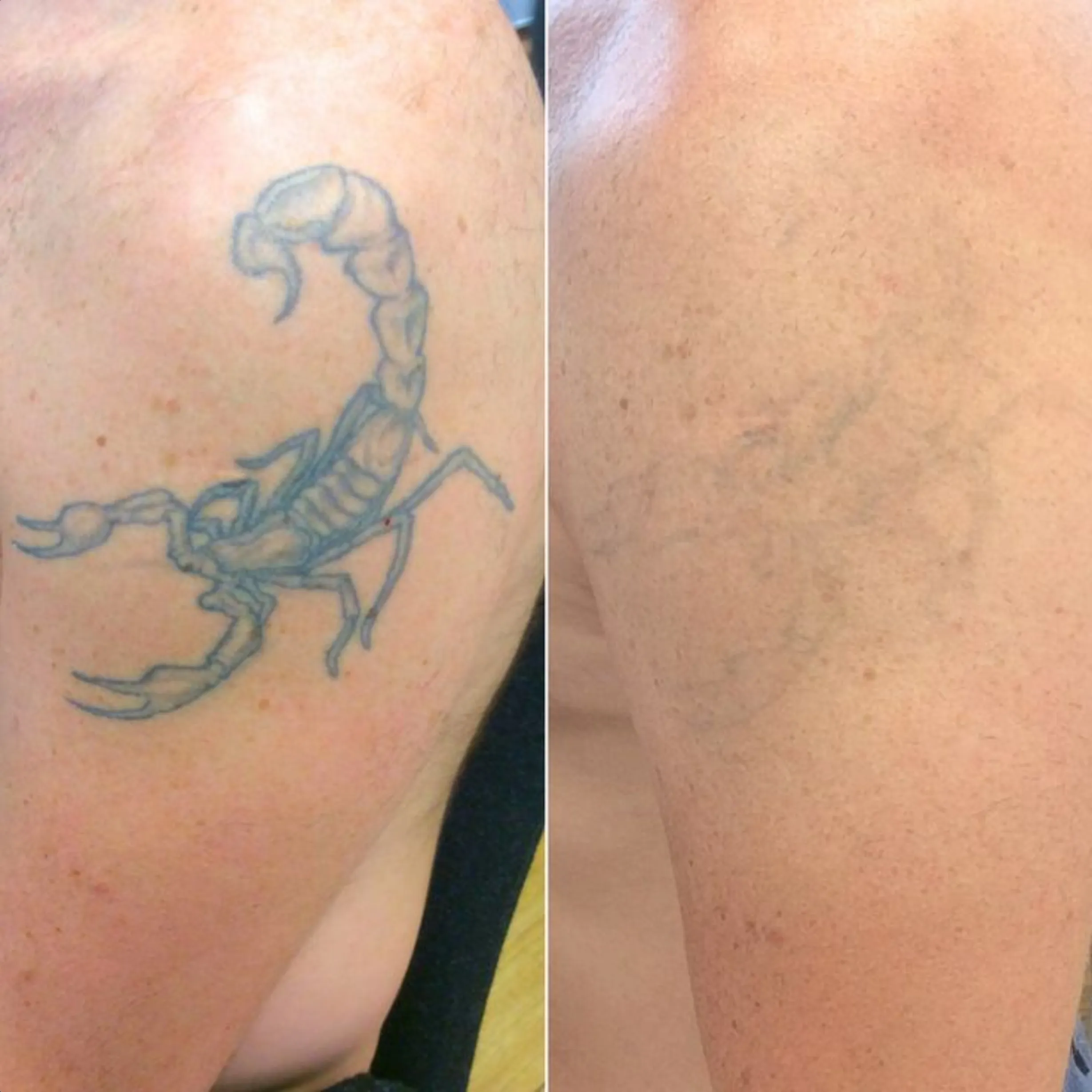 why tattoo creams are risky