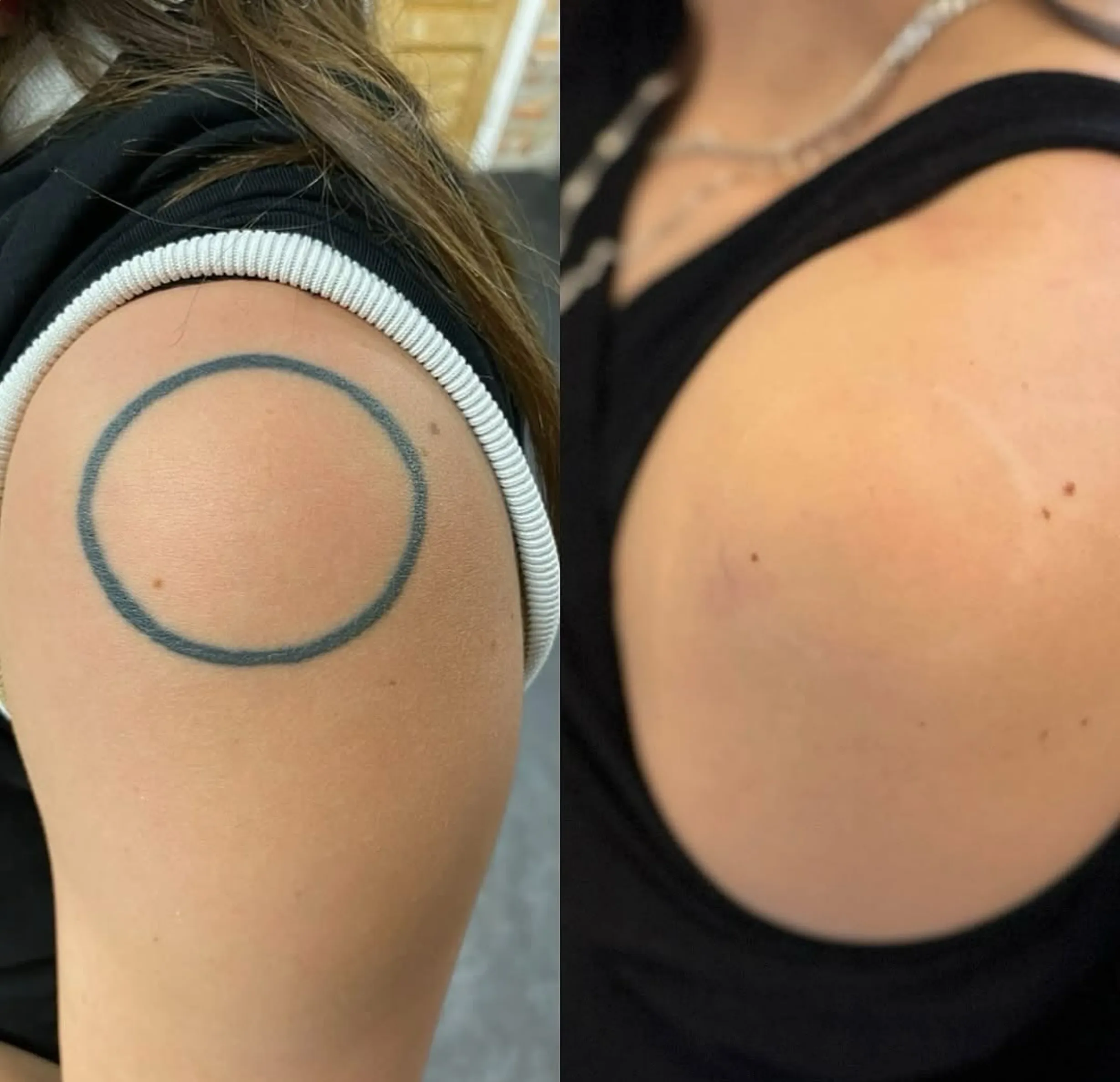 tattoo removal on a budget
