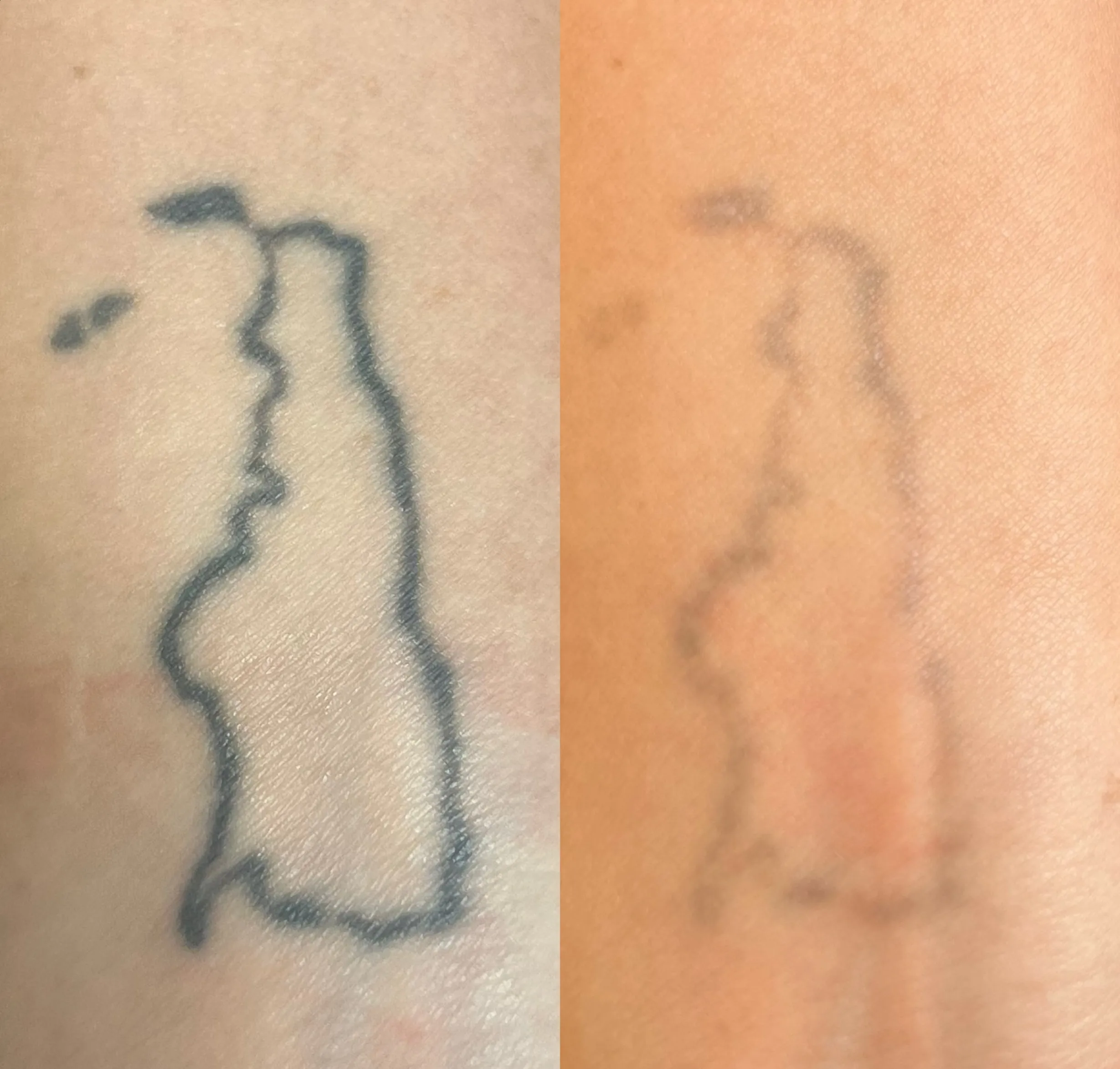 laser vs cream tattoo removal