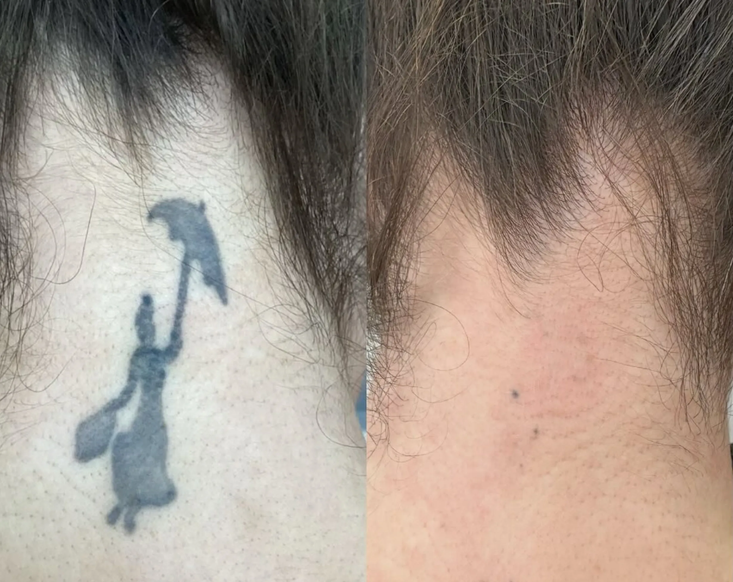 saline tattoo removal cost
