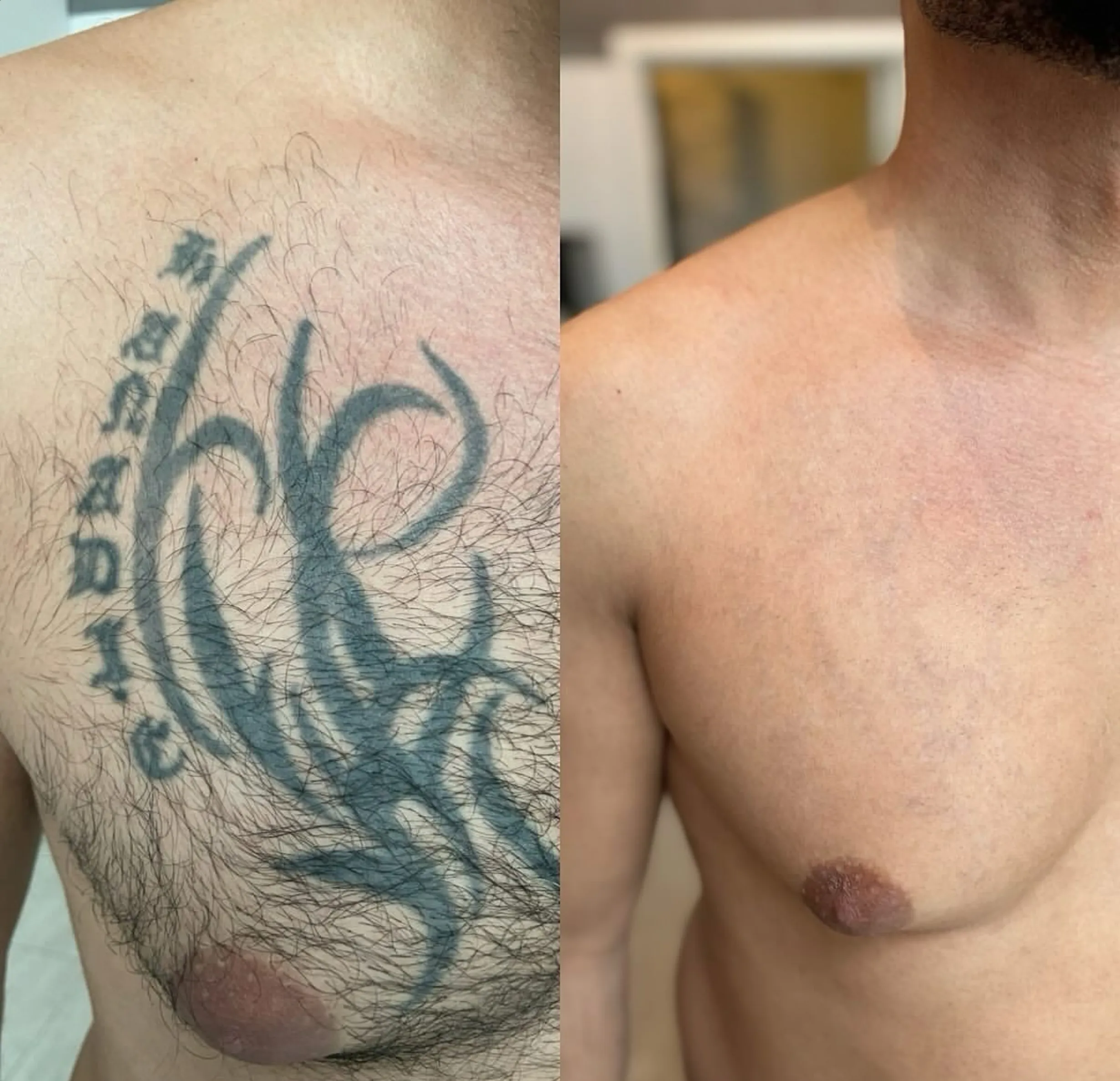 tattoo removal cost Brisbane