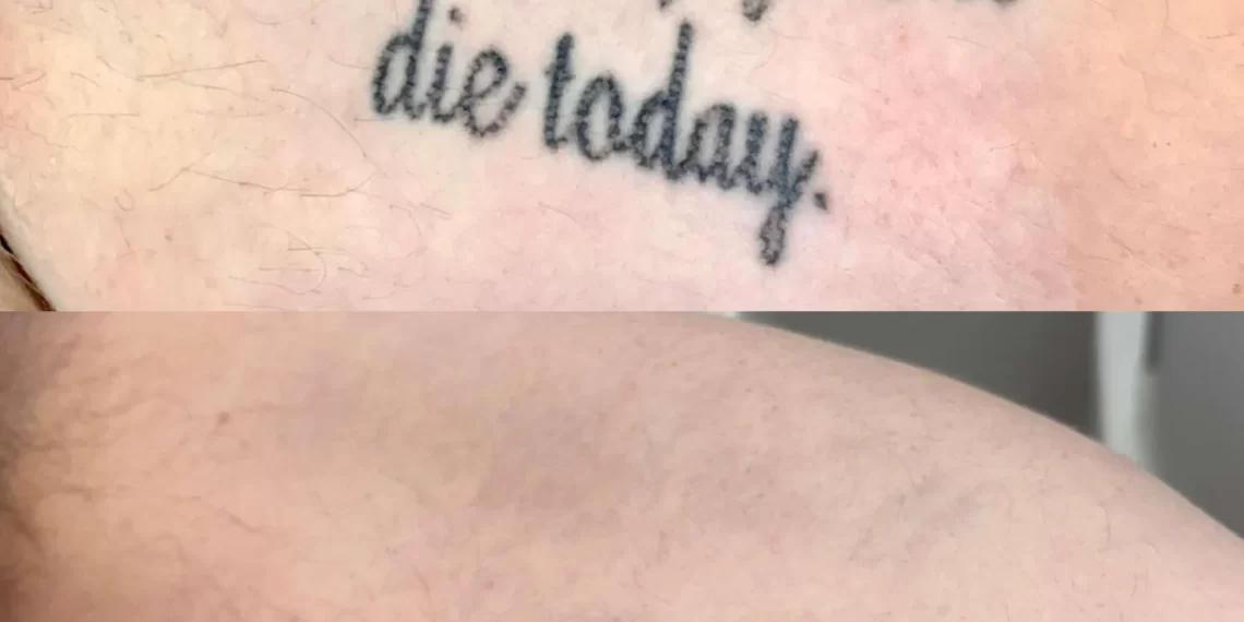 Cheapest Way to Remove a Tattoo